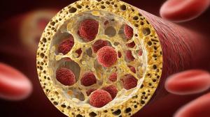 Cross-sectional graphic illustrating bone marrow fibrosis impact on stem cell niches and blood production decline. | Image Credit: Justlight | stock.adobe.com