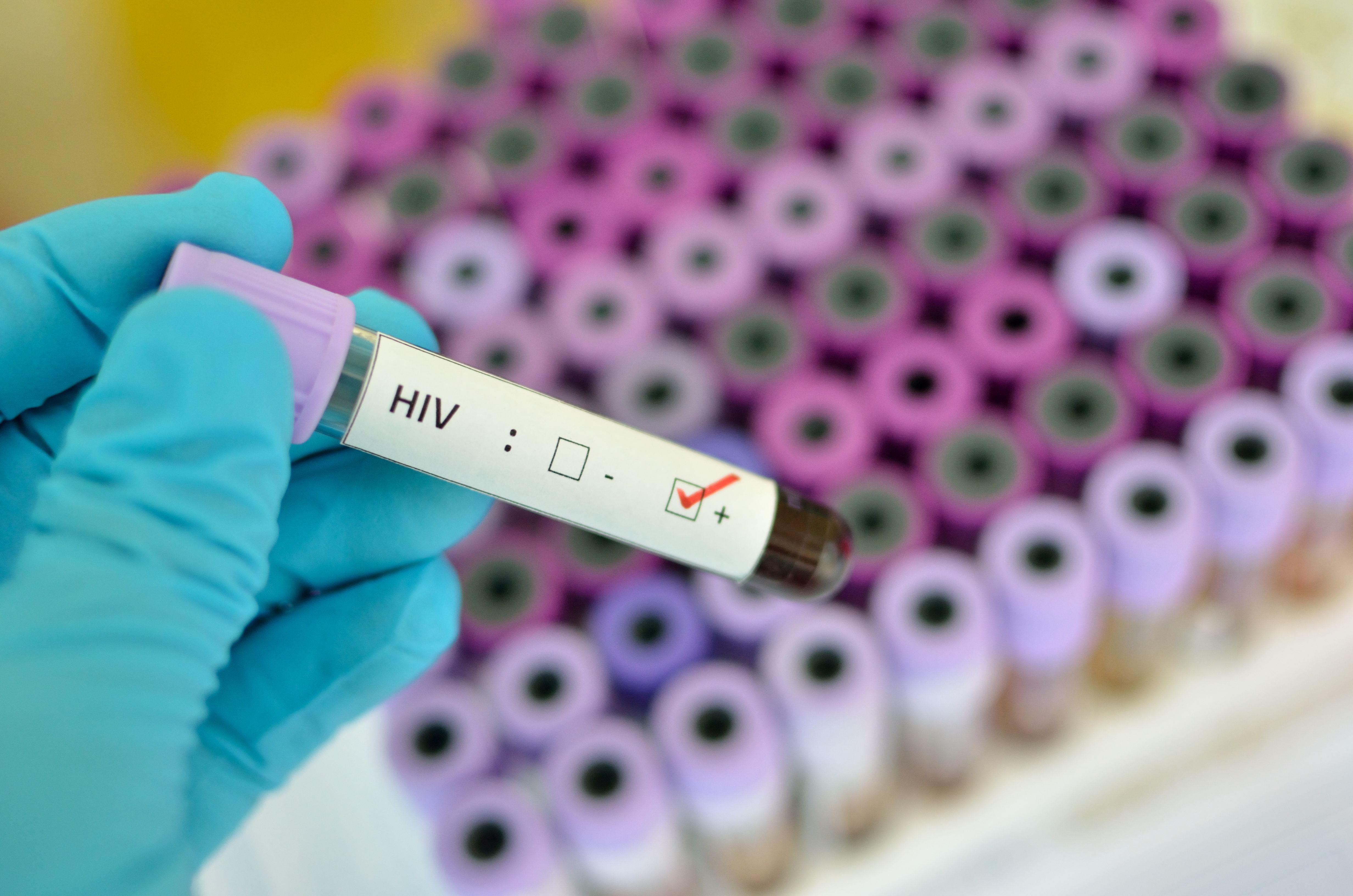 Positive HIV blood test -- Image credit: jarun011 | stock.adobe.com
