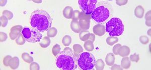 Small Molecule Inhibitors for the Treatment of Chronic Lymphocytic Leukemia