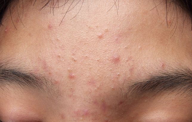 can retatrutide cause acne How Do Chemical Peels Treat & Acne Scars? can retatrutide cause acne The