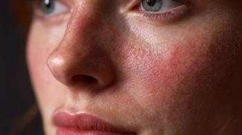 Beyond Skin Clearance: What Litifilimab Could Mean for Cutaneous Lupus Care