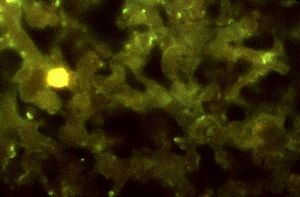 Management of Community-Acquired Pneumonia in Adults