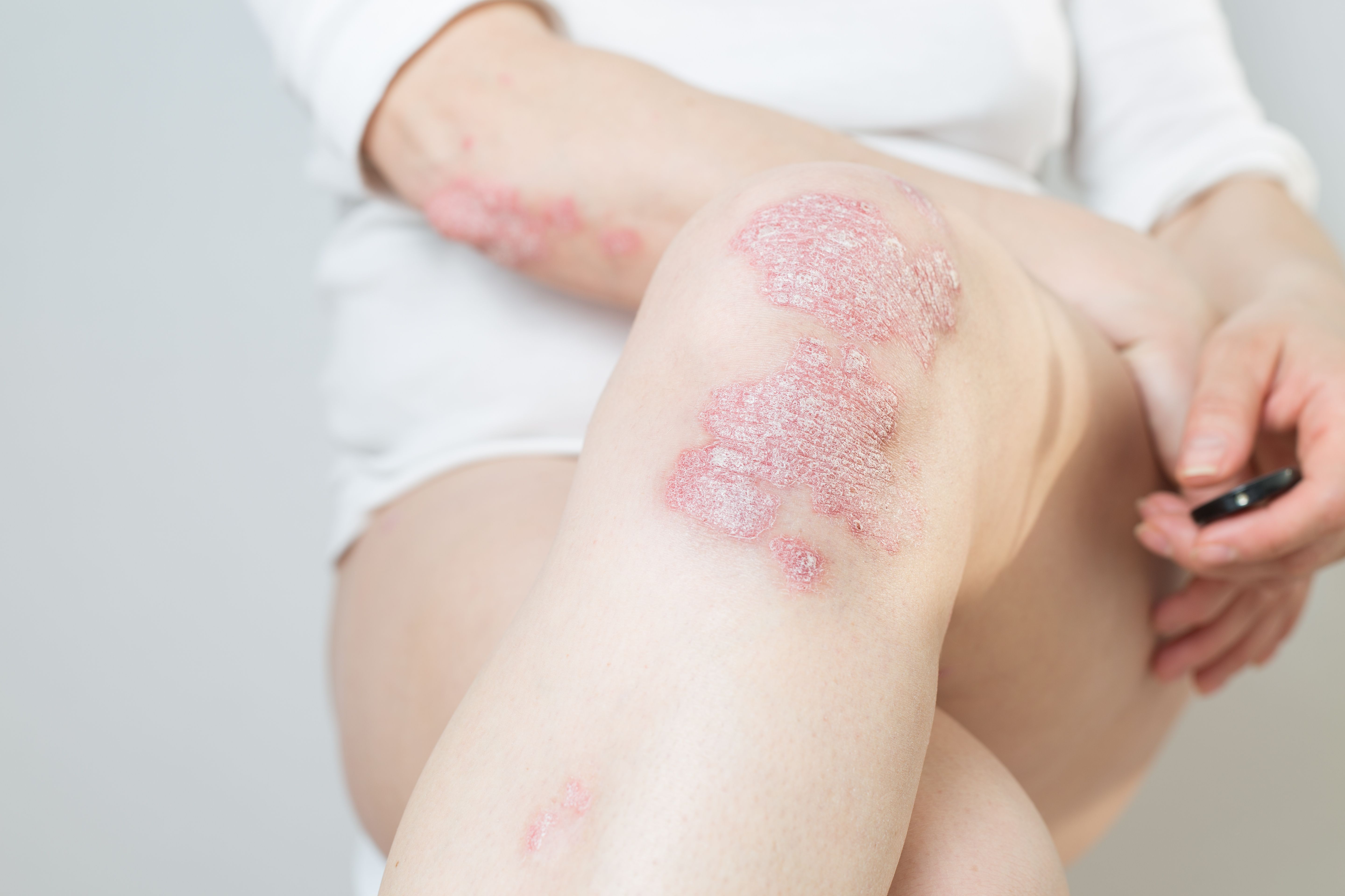 Acute psoriasis on the knees ,body ,elbows is an autoimmune incurable dermatological skin disease. Large red, inflamed, flaky rash on the knees. Joints affected by psoriatic arthritis - Image credit: SNAB | stock.adobe.com