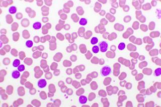 Safety, Efficacy of BOVen Therapy in Patients With Previously Untreated CLL
