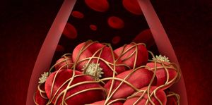 Apixaban: A New Treatment Option for Cancer-Associated VTE