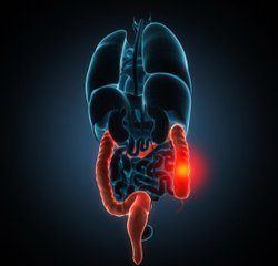 Clinical Overview: Risankizumab-rzaa for Crohn Disease