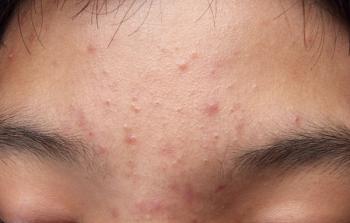 Acne