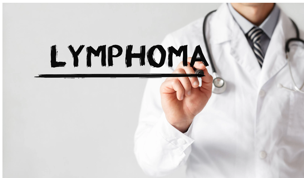 Mosunetuzumab Led to Durable Complete Response in Majority of Patients with Lymphoma During Follow-Up Study - Vimarsana News