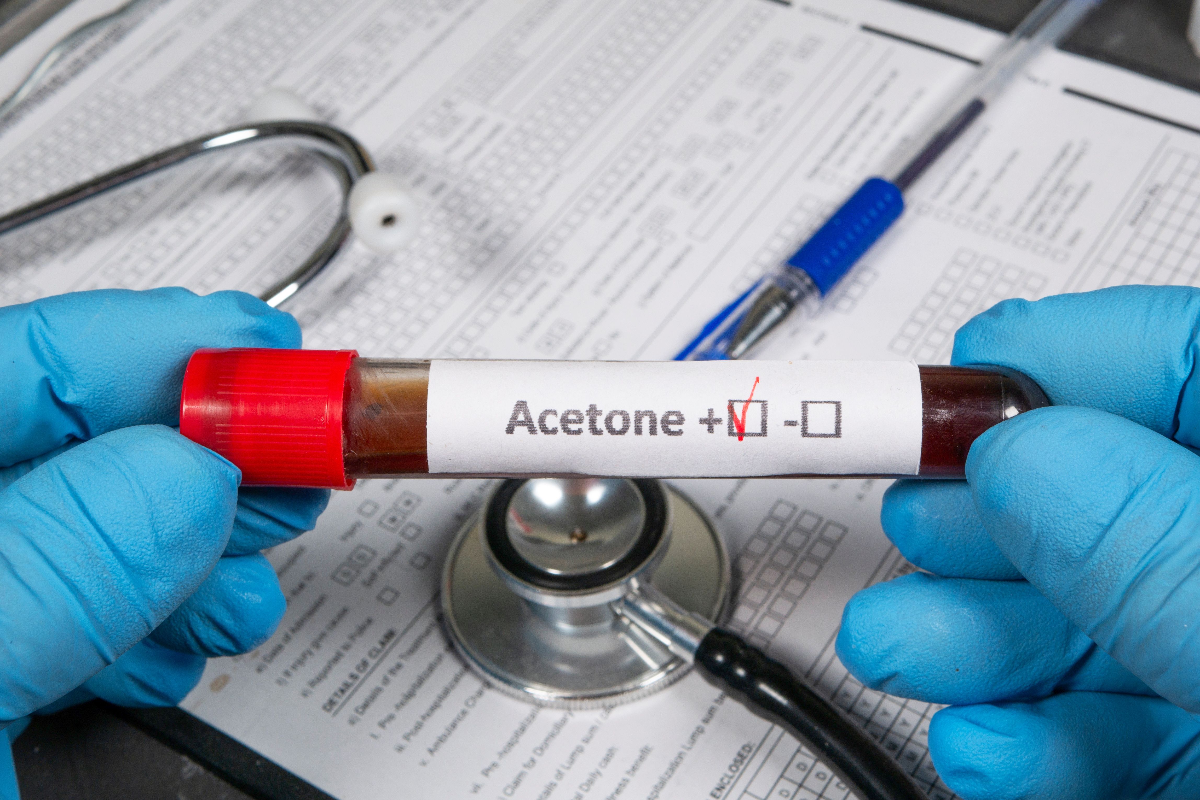 Doctor holding test tube with acetone positive result and stethoscope - Image credit: Богдан Стеблянко | stock.adobe.com