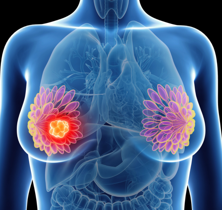 Men with stage IV breast cancer benefit from trimodal therapy