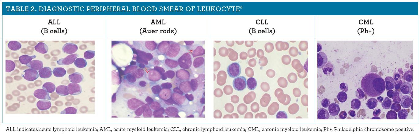 Leukemia Count Leukemia: Causes, Symptoms, and Treatments