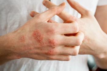 The problem with many people - eczema on hand. White background. Man scratching skin.