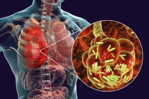 Managing Drug Interactions in HIV and TB Coinfection Is Complex