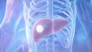 Ivonescimab Combination Improves Overall Survival in First-Line Advanced Biliary Tract Cancer