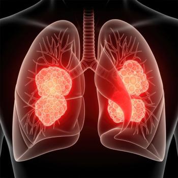 Lung Cancer - Medical Illustration of Tumors. | Image Credit: emershy 032 | stock.adobe.com