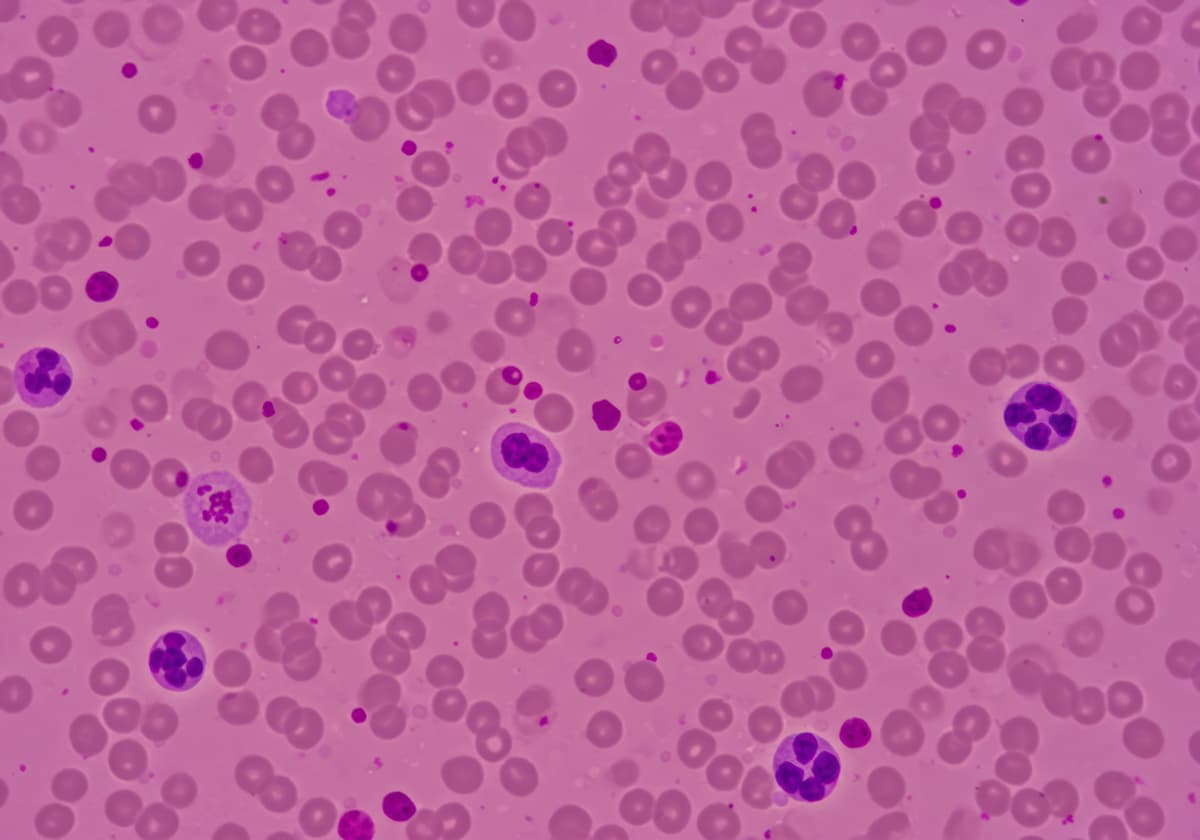 Microscopic View of Hematological Slide Showing Thrombocytopenia and Low Platelet Count in Blood