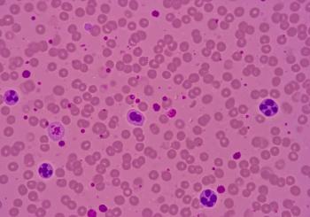 Microscopic View of Hematological Slide Showing Thrombocytopenia and Low Platelet Count in Blood