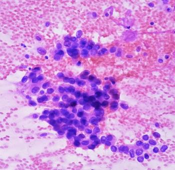 Extensive stage small cell lung cancer (ES-SCLC) -- Image credit: Saiful52 | stock.adobe.com