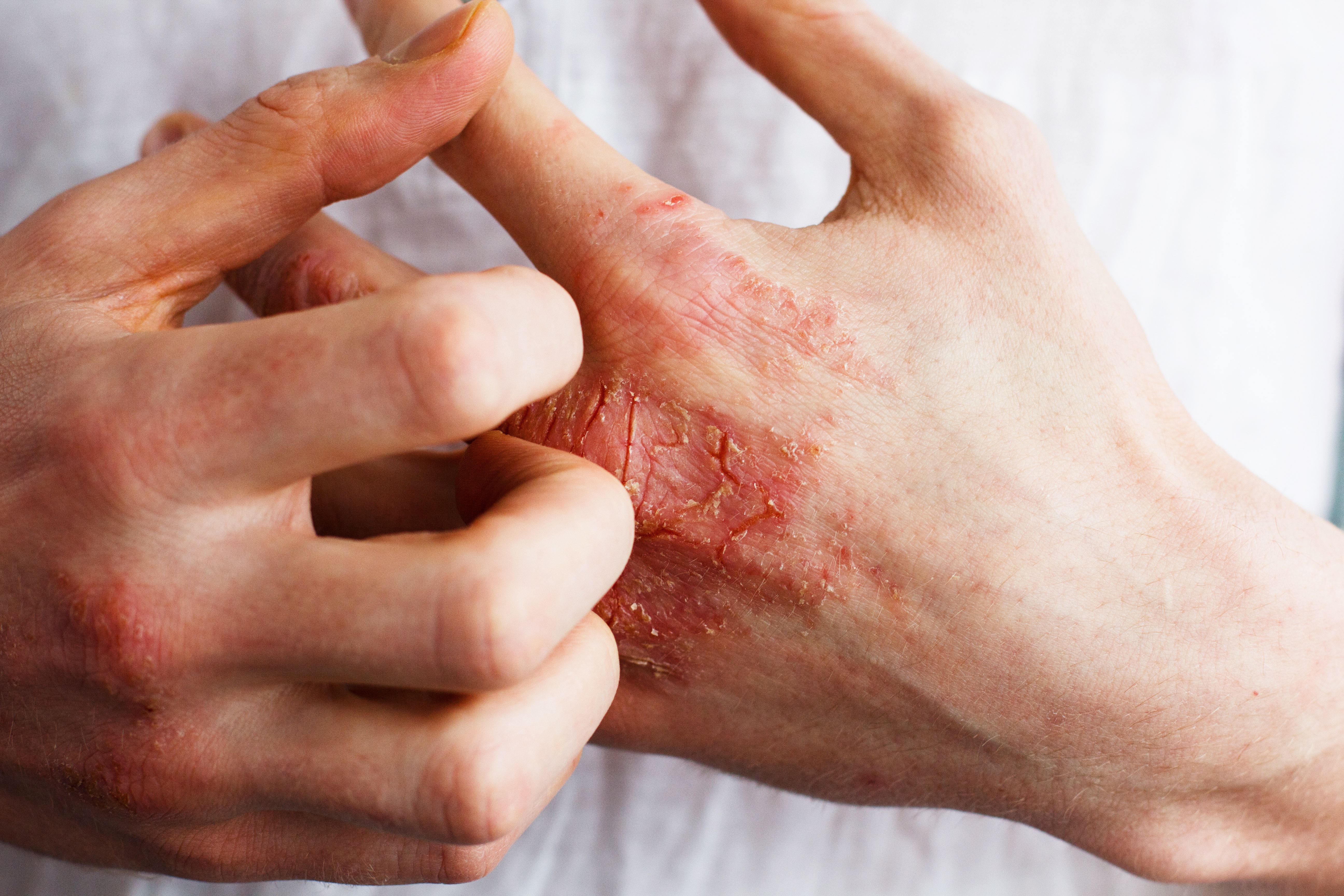 Patient with psoriasis, psoriatic arthritis -- Image credit: Ольга Тернавская | stock.adobe.com