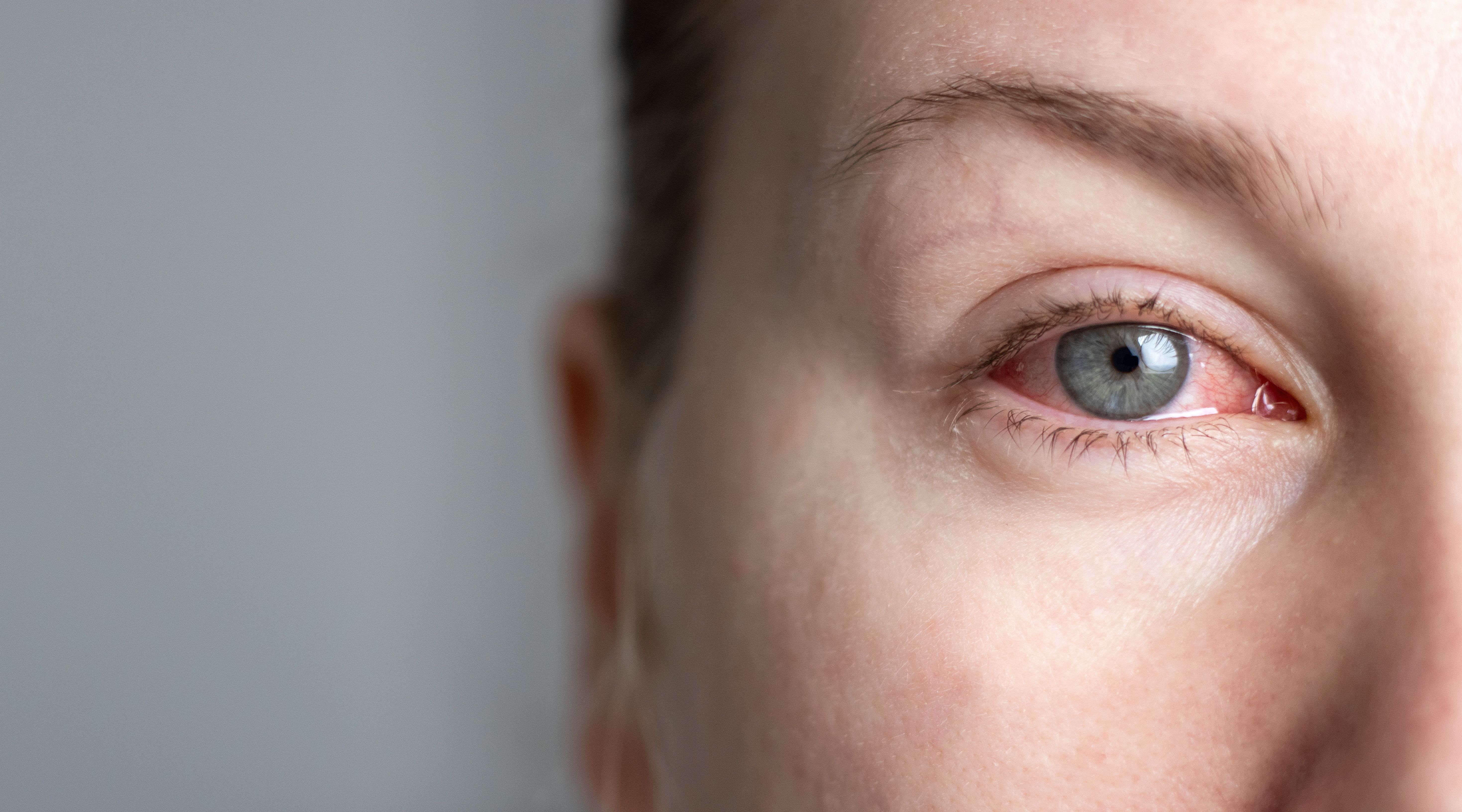 Irritated and red eye -- Image credit: TatjanaMeininger | stock.adobe.com