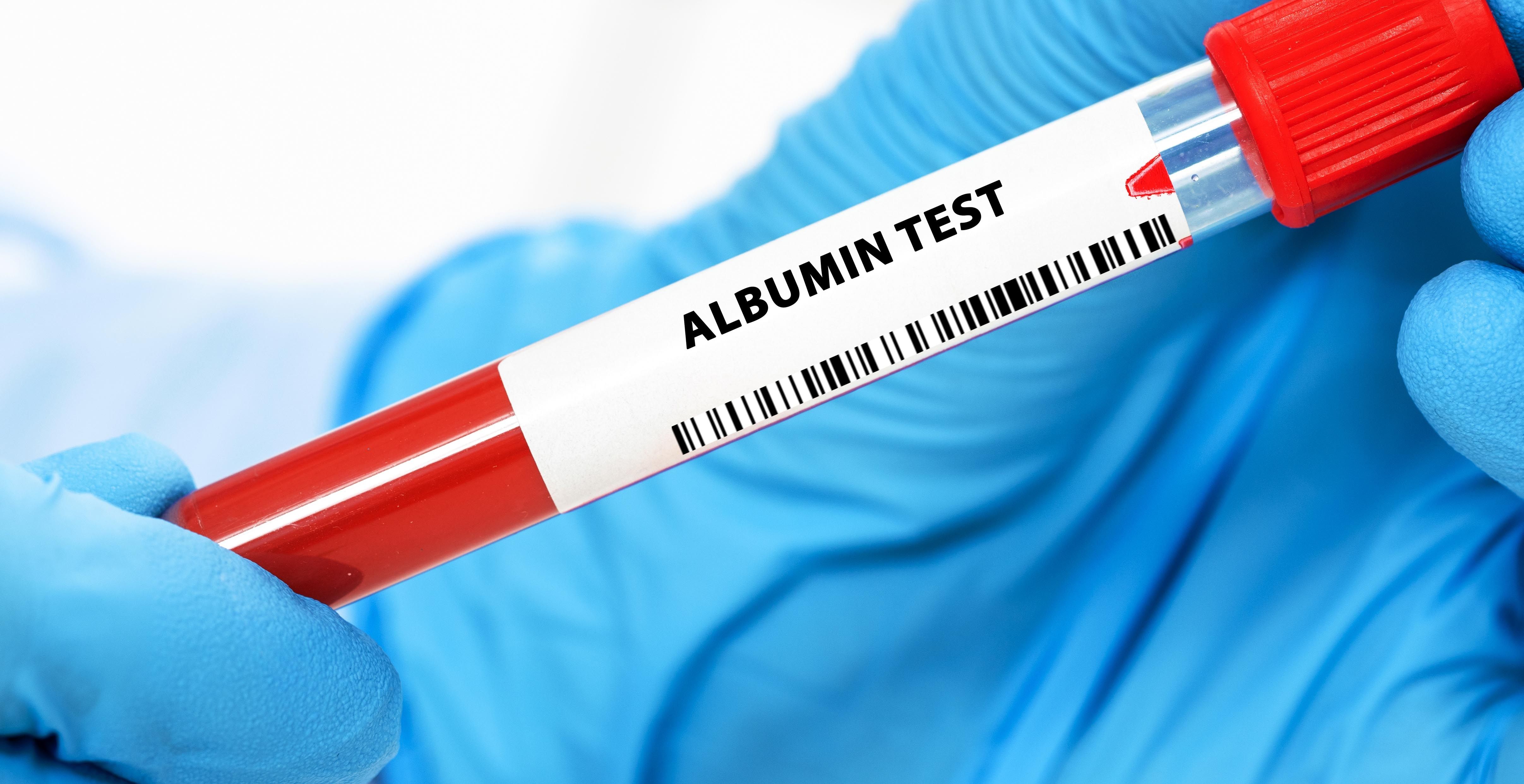 Albumin test for kidney function -- Image credit: luchschenF | stock.adobe.com