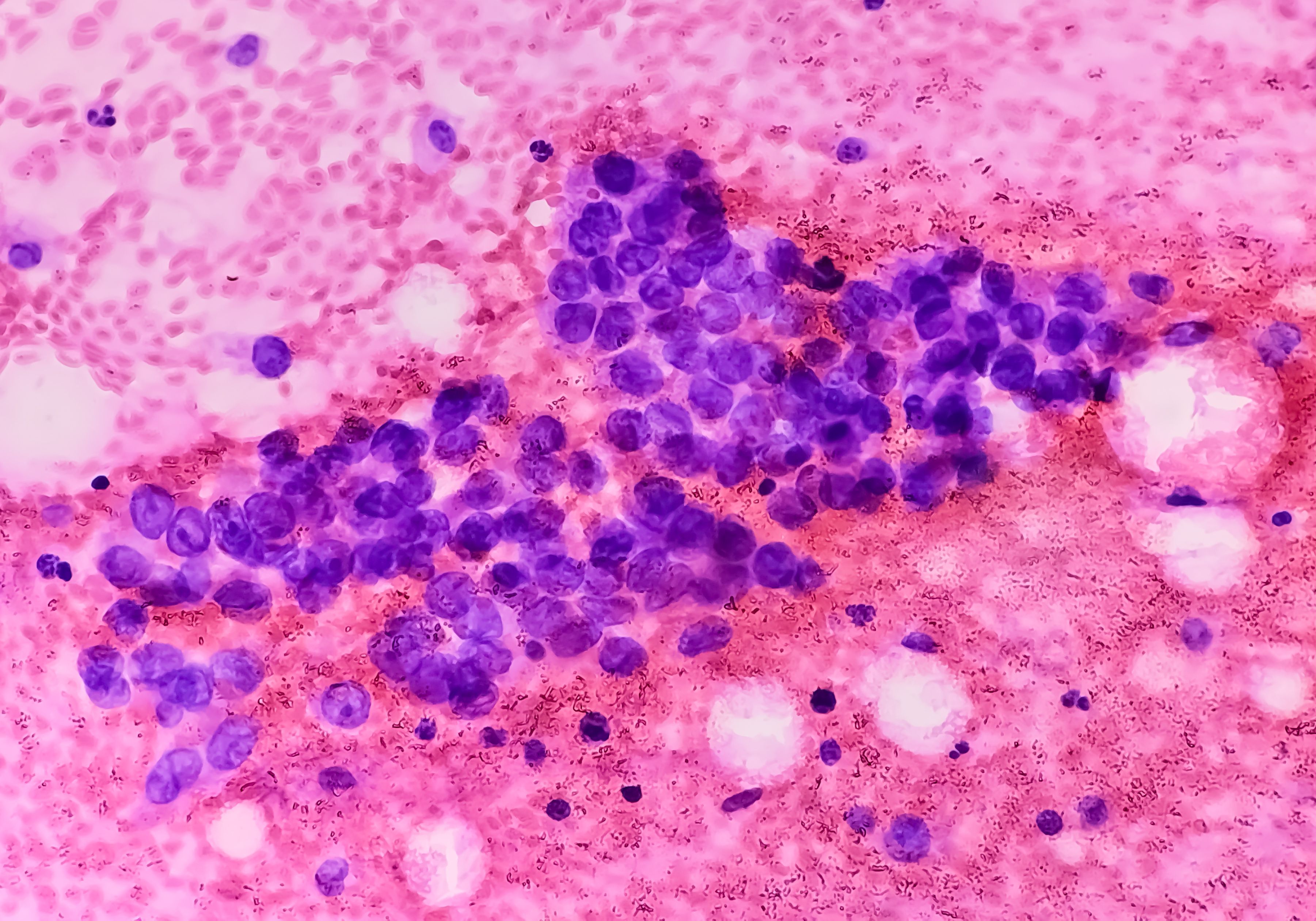 Small cell lung cancer (SCLC) -- Image credit: Saiful52 | stock.adobe.com
