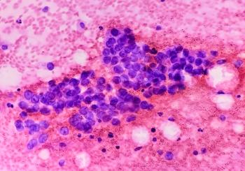 Small cell lung cancer (SCLC) -- Image credit: Saiful52 | stock.adobe.com