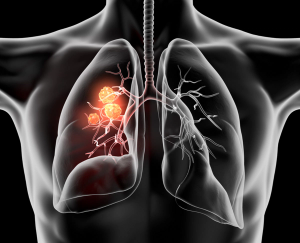 Addition of Tremelimumab-actl to Durvalumab-Based Regimen May Broaden Clinical Activity in uHCC, mNSCLC