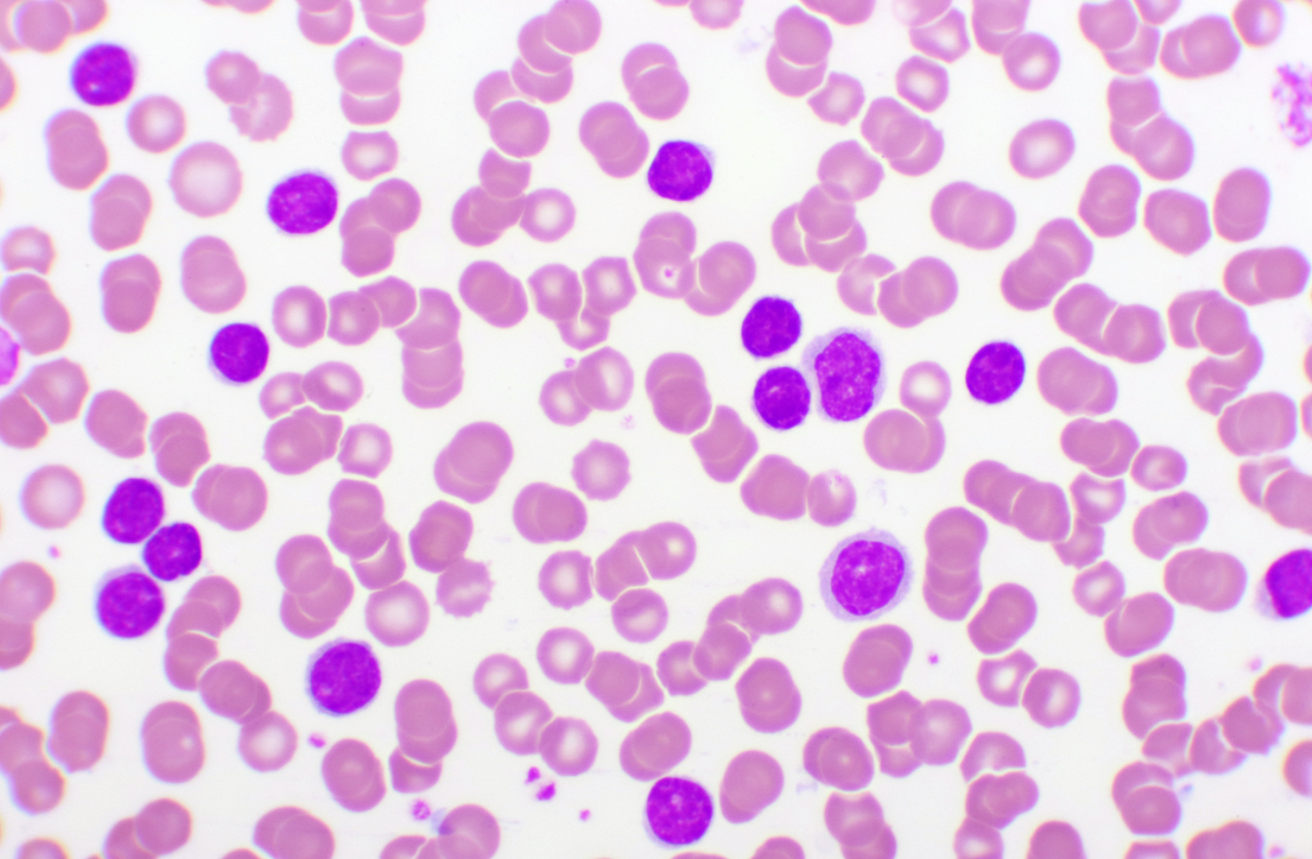 AMG 701 Demonstrates Manageable Safety, Favorable Pharmacokinetic Profile in Patients with Relapsed, Refractory Multiple Myeloma