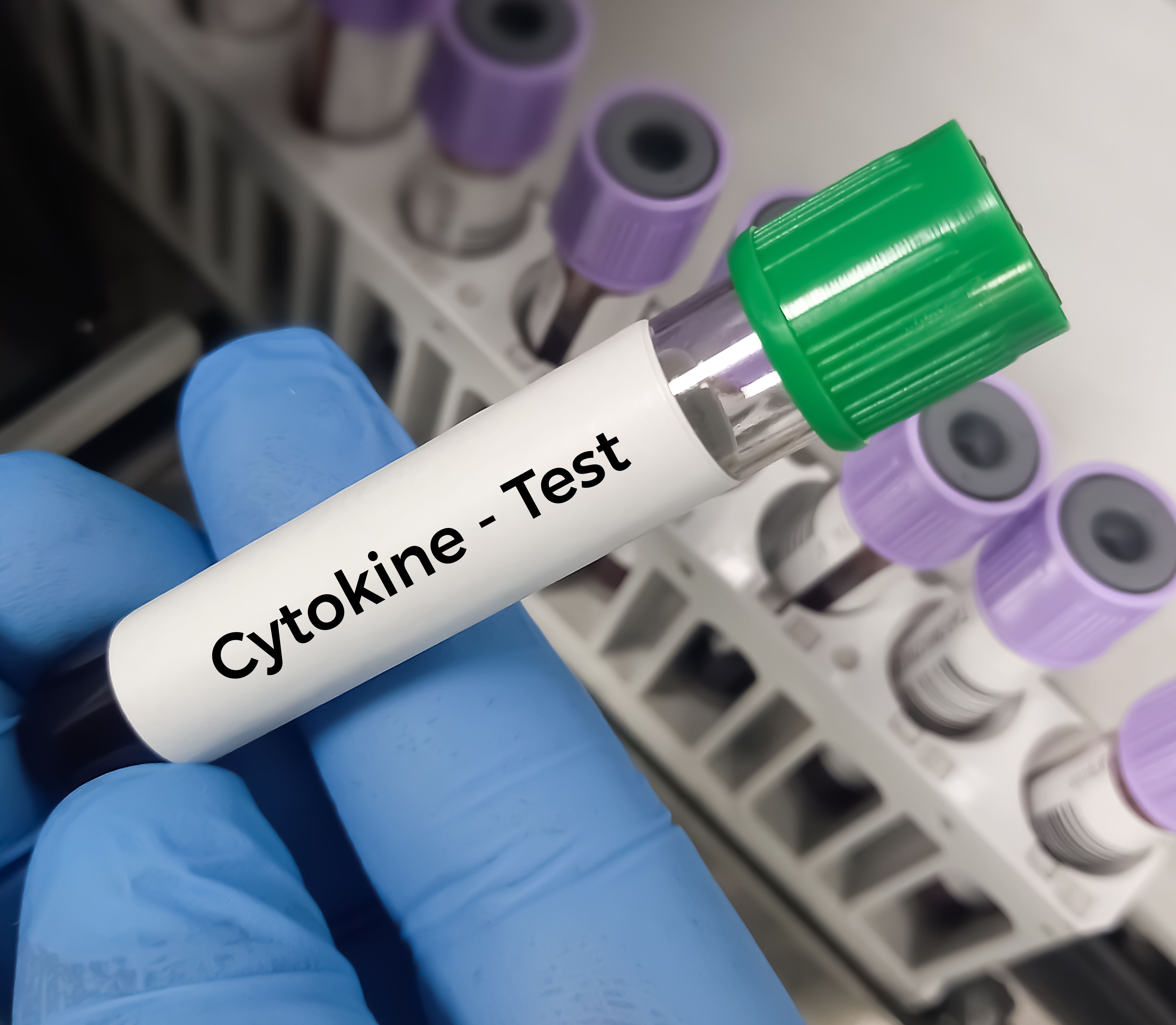 Blood sample for Cytokine test, used to pathophysiology of immune, infectious, or inflammatory disorders. Cytokine Release Syndrome - Image credit: MdBabul | stock.adobe.com
