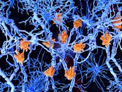 Multiple sclerosis (MS) -- Image credit: Juan Gärtner | stock.adobe.com