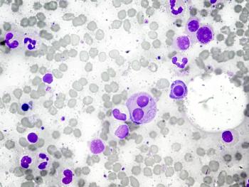 Could Linvoseltamab Change When We Treat High-Risk Smoldering Myeloma?