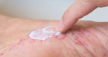 Applying topical cream to irritated skin | Image Credit: @ chatuphot - stock.adobe.com