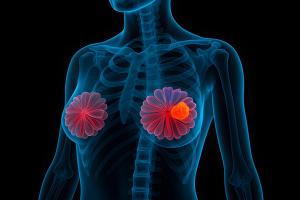3D medical illustration of breast cancer | Image Credit: © Ram - stock.adobe.com