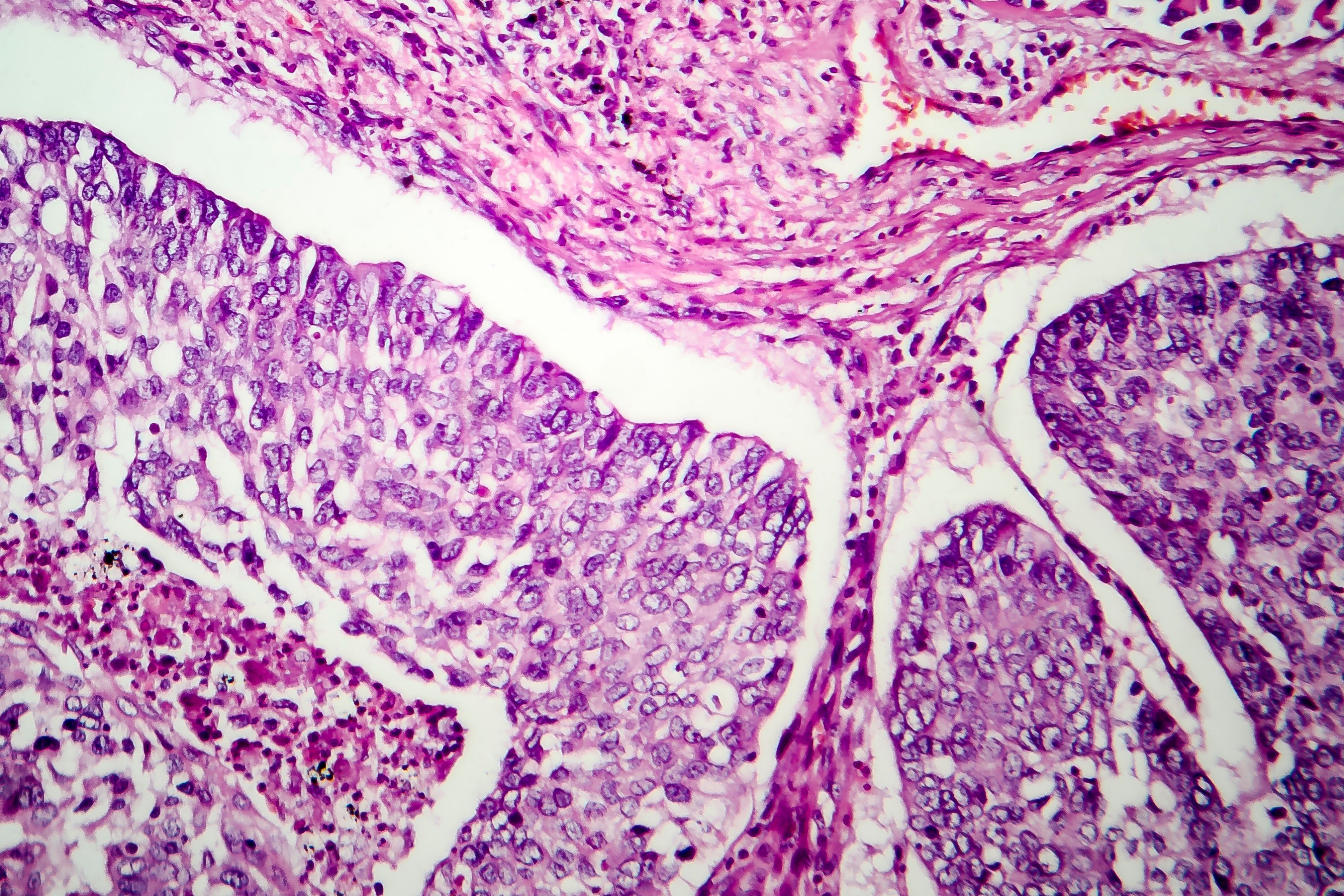 Extensive stage-small cell lung cancer (ES-SCLC) -- Image credit: Dr_Microbe | stock.adobe.com