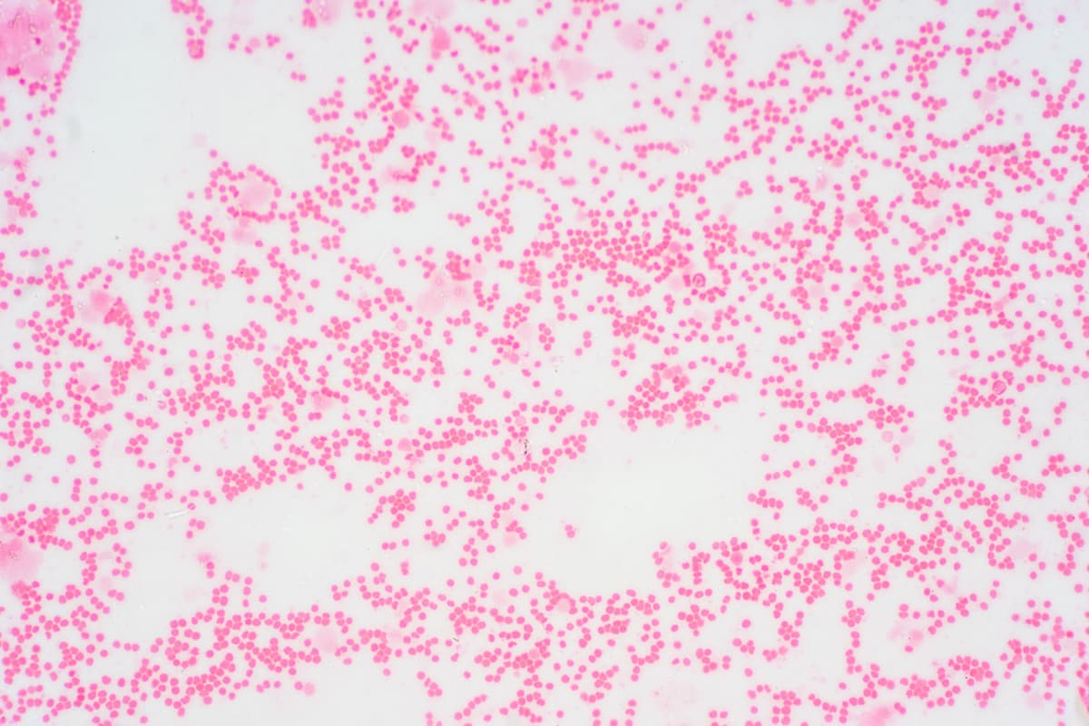 Bone marrow biopsy from myelodysplastic condition under the microscope view.