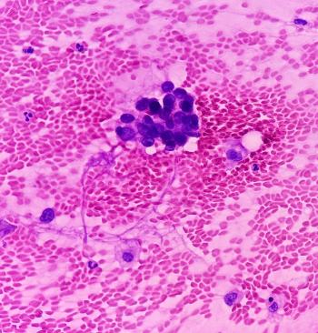 Non-small cell lung cancer (NSCLC) -- Image credit: MdBabul | stock.adobe.com
