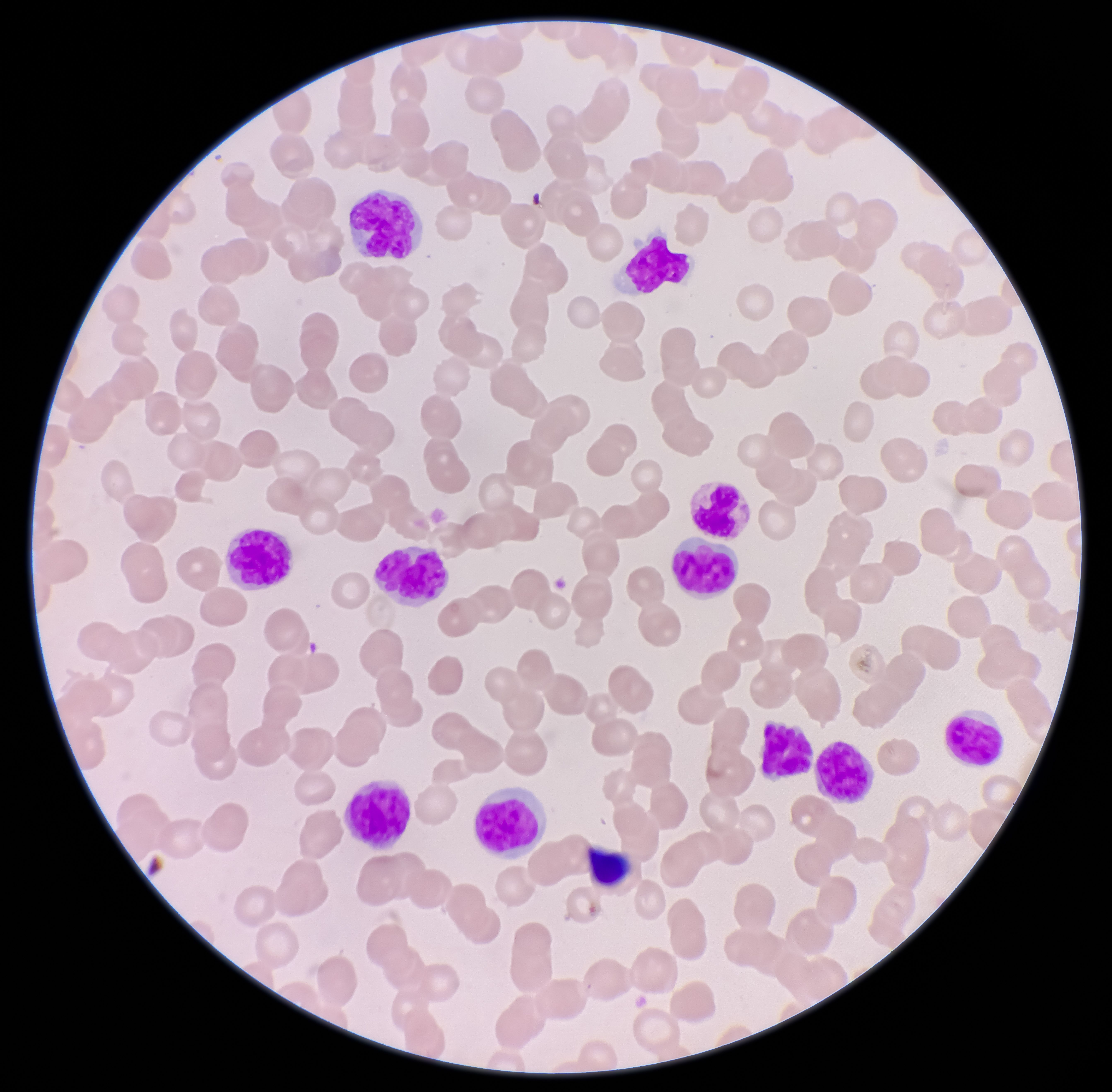 AI Model Can Differentiate Prefibrotic Primary Myelofibrosis From Essential Thrombocythemia With High Accuracy
