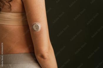 MINSK, BELARUS - MARCH 11, 2025: blood sugar monitor on her arm. Dexcom One Plus. Life with diabetes - Image credit: Dulin | stock.adobe.com