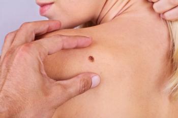 FDA approves cemiplimab for CSCC -- Image credit: dream@do | stock.adobe.com