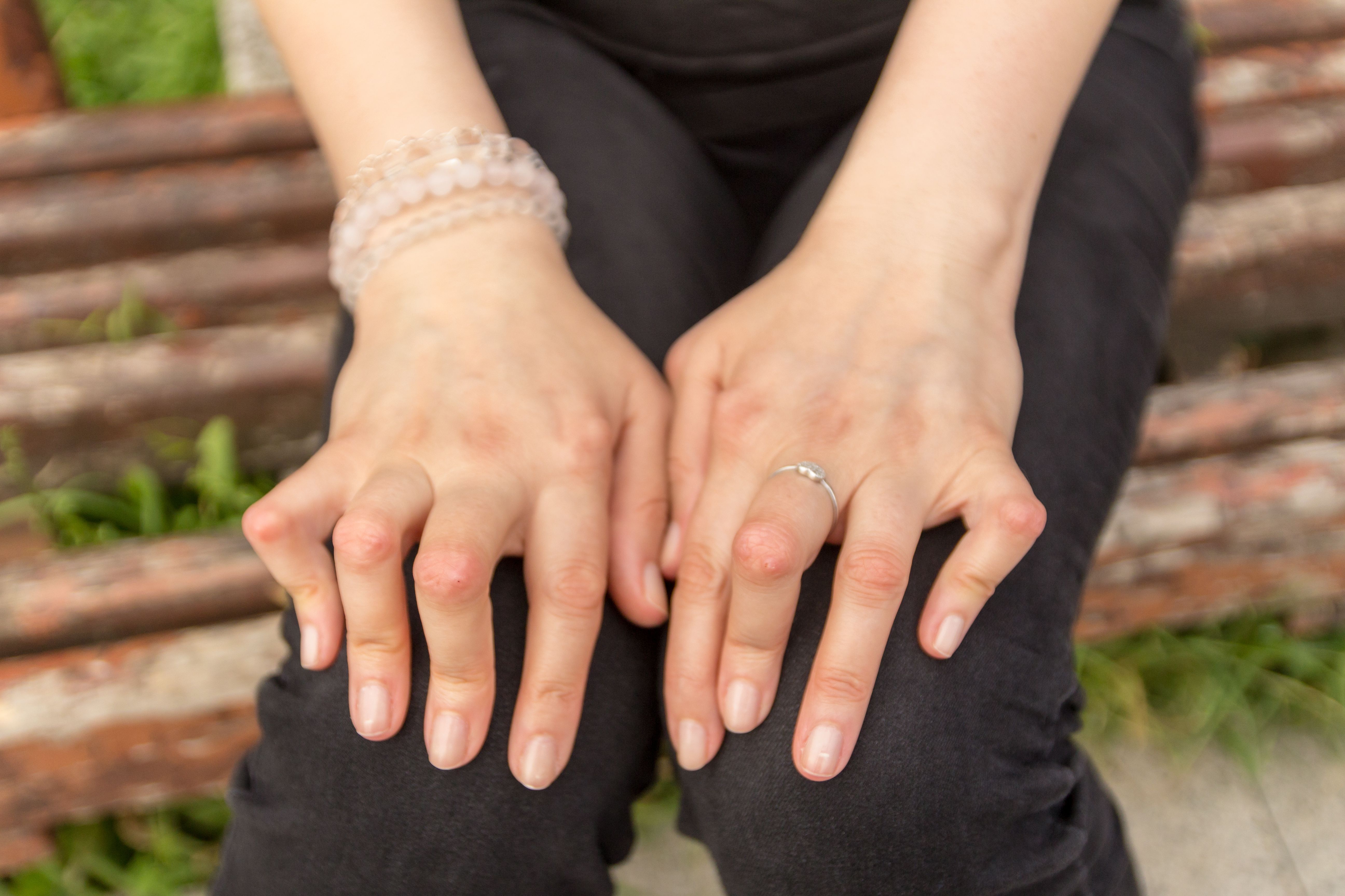 Patient with rheumatoid arthritis (RA) -- Image credit: Valentina | stock.adobe.com