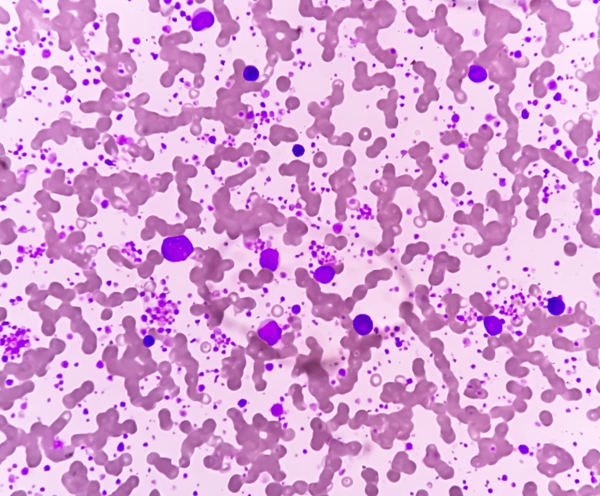 Chronic myeloid leukemia (CML) in accelerated phase with thrombocytosis.