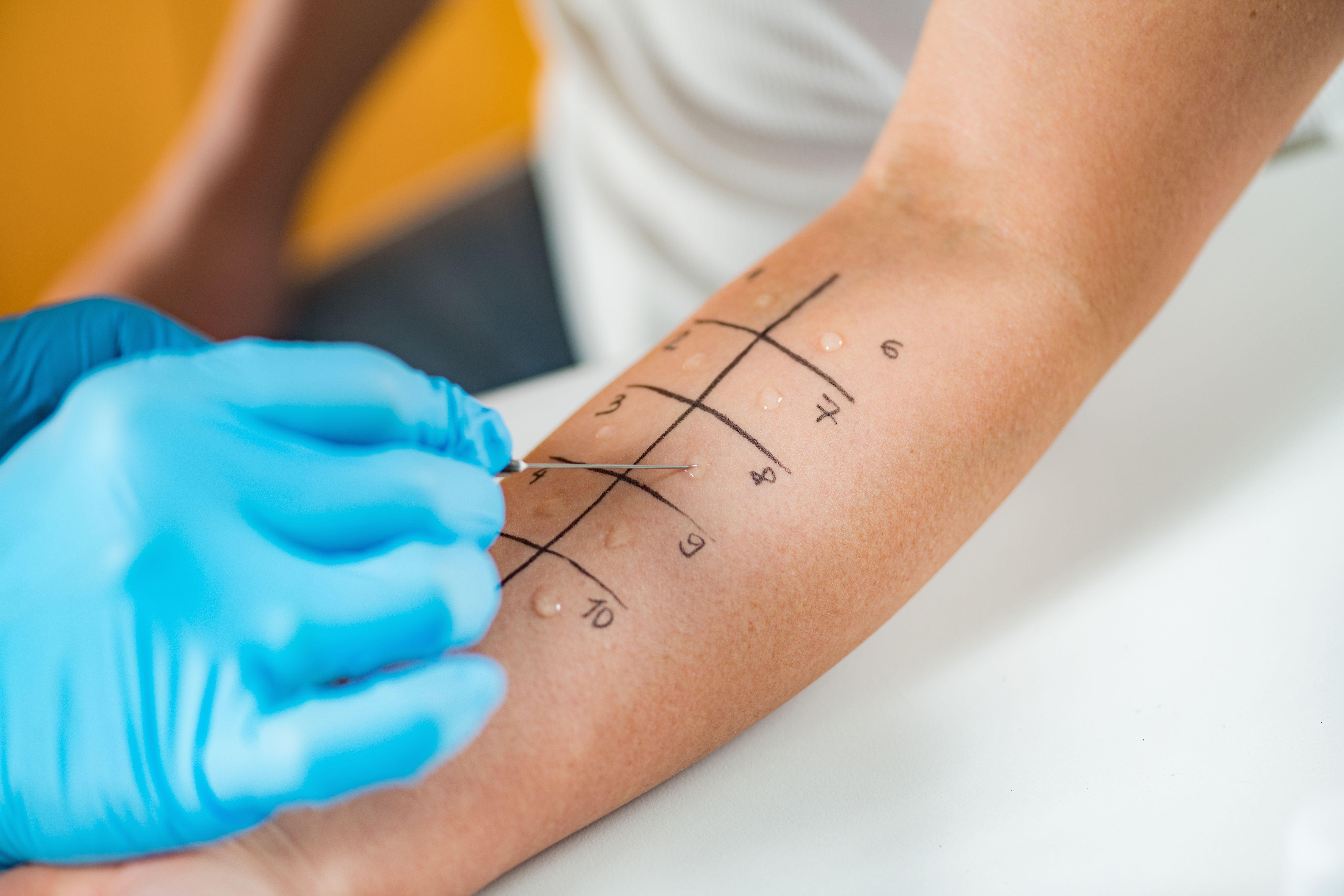 Patient with asthma undergoing allergen skin testing -- Image credit: Microgen | stock.adobe.com