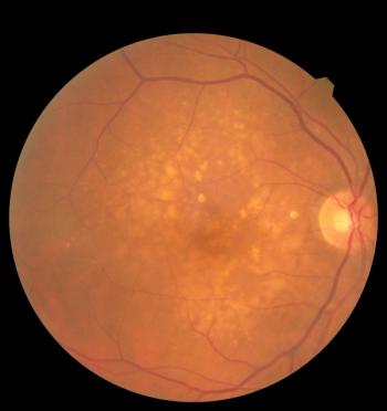 Macular degeneration -- Image credit: Ольга Тернавская | stock.adobe.com