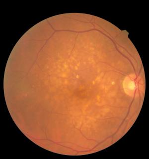Macular degeneration -- Image credit: Ольга Тернавская | stock.adobe.com