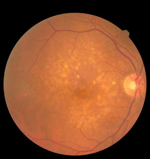 Macular degeneration -- Image credit: Ольга Тернавская | stock.adobe.com