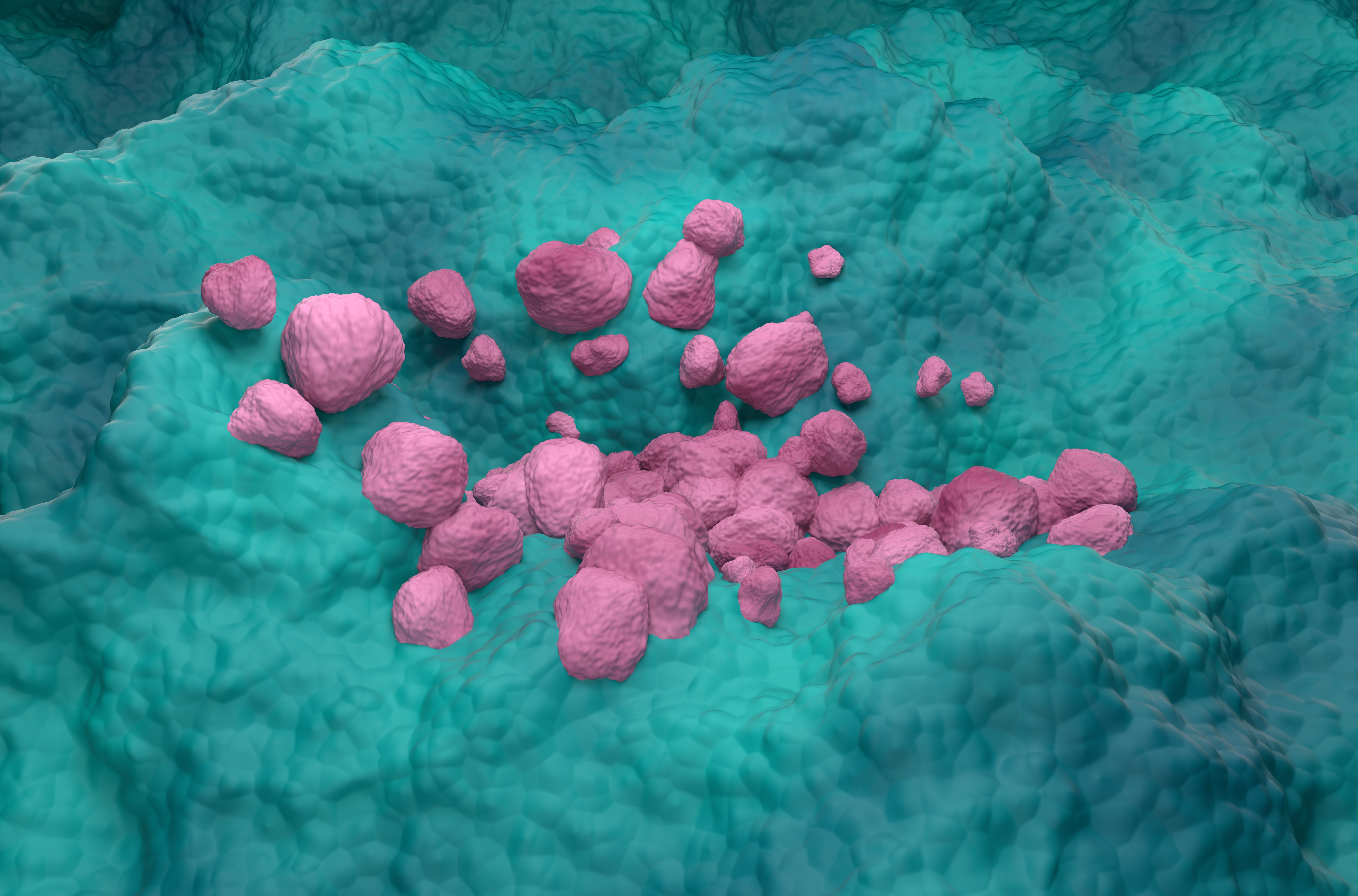 Non Small Cell Lung Cancer (NSCLC) in the lung tissue – isometric view 3d illustration - Image credit: LASZLO | stock.adobe.com