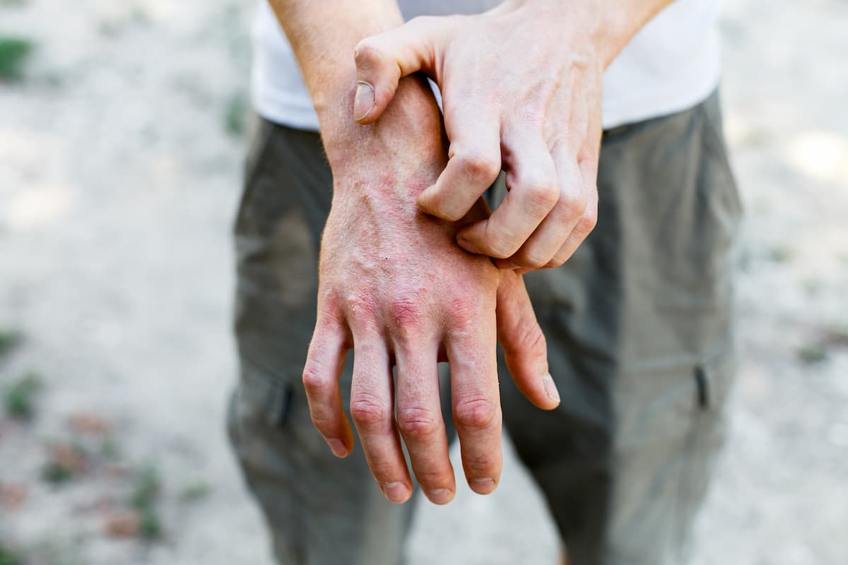 Close up dermatitis on skin, ill allergic rash eczema skin of patient , atopic dermatitis symptom skin detail texture