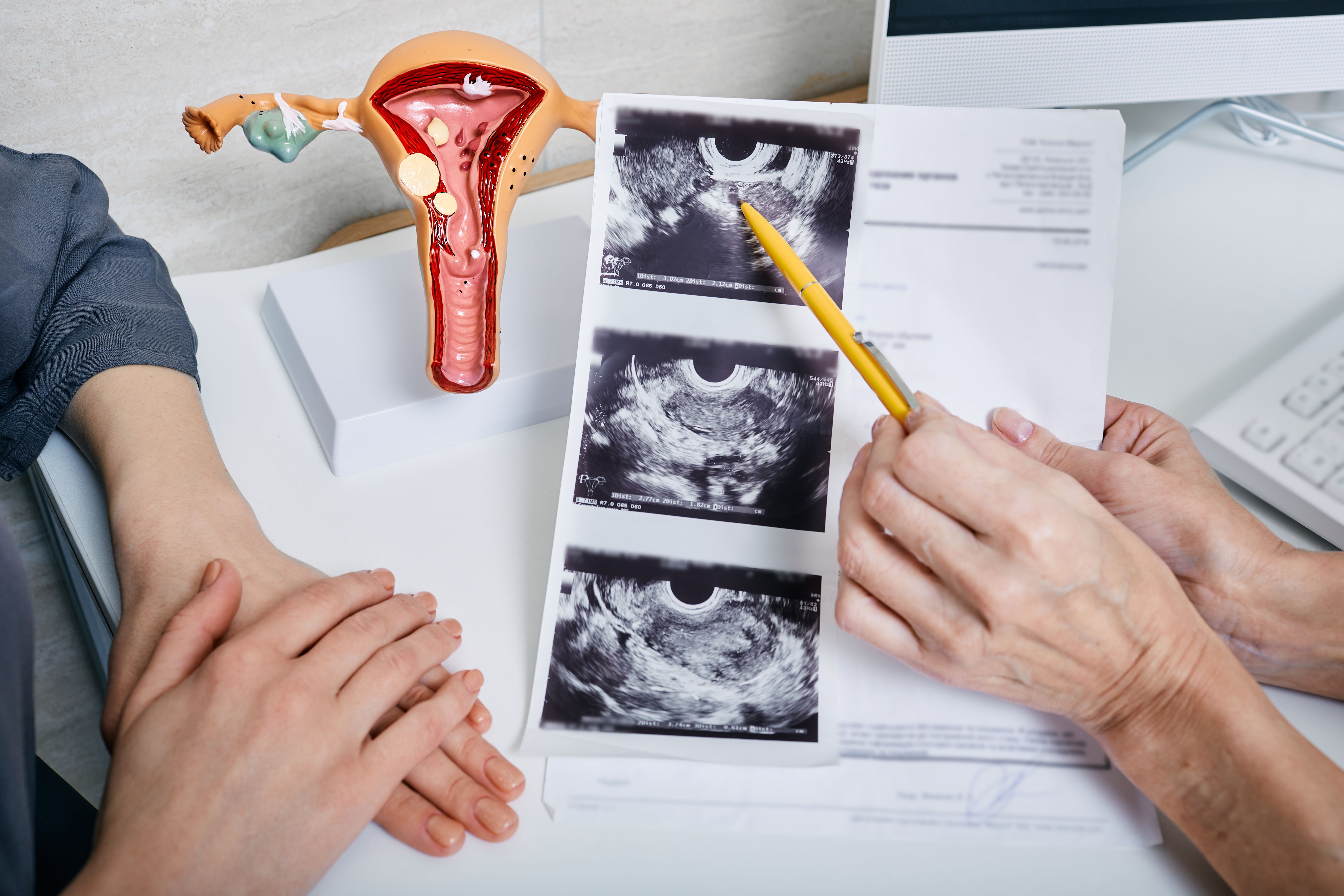 Model and ultrasound images showing uterine fibroids -- Image credit: Peakstock | stock.adobe.com