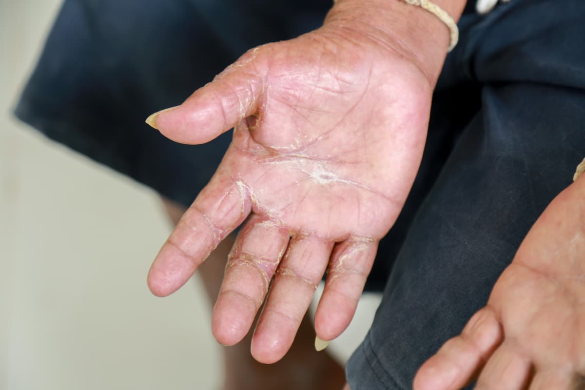 Skin disorder, pepper appearance from scleroderma, autoimmune disease male hand Skin disorder pepper appearance from vitiligo,scleroderma raynaud, medical concept autoimmune disease.